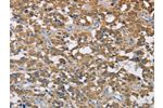 The image on the left is immunohistochemistry of paraffin-embedded Human thyroid cancer tissue using CSB-PA063818(CST2 Antibody) at dilution 1/50, on the right is treated with fusion protein. (Original magnification: 