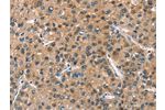 The image on the left is immunohistochemistry of paraffin-embedded Human liver cancer tissue using CSB-PA064362(ASB2 Antibody) at dilution 1/40, on the right is treated with fusion protein. (Original magnification: 