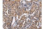 The image on the left is immunohistochemistry of paraffin-embedded Human lung cancer tissue using CSB-PA064553(TLR2 Antibody) at dilution 1/50, on the right is treated with fusion protein. (Original magnification: 