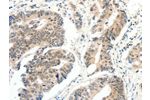 The image on the left is immunohistochemistry of paraffin-embedded Human colon cancer tissue using CSB-PA064607(FAM3A Antibody) at dilution 1/30, on the right is treated with fusion protein. (Original magnification: 