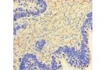 Immunohistochemistry of paraffin-embedded human ovarian cancer using CSB-PA06475A0Rb at dilution of 1:100