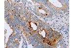 The image on the left is immunohistochemistry of paraffin-embedded Human cervical cancer tissue using CSB-PA064902(ENPP6 Antibody) at dilution 1/15, on the right is treated with fusion protein. (Original magnification: 