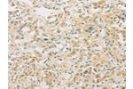 The image on the left is immunohistochemistry of paraffin-embedded Human thyroid cancer tissue using CSB-PA064938(FNTA Antibody) at dilution 1/30, on the right is treated with fusion protein. (Original magnification: 