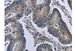 The image on the left is immunohistochemistry of paraffin-embedded Human colon cancer tissue using CSB-PA065045(GJC2 Antibody) at dilution 1/40, on the right is treated with synthetic peptide. (Original magnification: 
