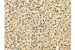 The image on the left is immunohistochemistry of paraffin-embedded Human prostate cancer tissue using CSB-PA065296(DNASE1 Antibody) at dilution 1/25, on the right is treated with fusion protein. (Original magnification: 