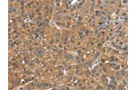 The image on the left is immunohistochemistry of paraffin-embedded Human liver cancer tissue using CSB-PA065723(CR1 Antibody) at dilution 1/25, on the right is treated with synthetic peptide. (Original magnification: 