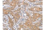The image on the left is immunohistochemistry of paraffin-embedded Human gastic cancer tissue using CSB-PA065886(ATG12 Antibody) at dilution 1/40, on the right is treated with fusion protein. (Original magnification: 