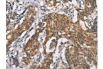 The image on the left is immunohistochemistry of paraffin-embedded Human gastic cancer tissue using CSB-PA066517(ADGRB2 Antibody) at dilution 1/25, on the right is treated with synthetic peptide. (Original magnification: 