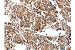 The image on the left is immunohistochemistry of paraffin-embedded Human breast cancer tissue using CSB-PA066650(FABP7 Antibody) at dilution 1/25, on the right is treated with fusion protein. (Original magnification: 