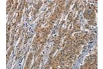 The image is immunohistochemistry of paraffin-embedded Human gastric cancer tissue using CSB-PA066696(AGER Antibody) at dilution 1/70. (Original magnification: 