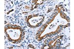 The image on the left is immunohistochemistry of paraffin-embedded Human stomach cancer tissue using CSB-PA066716(CPT1A Antibody) at dilution 1/25, on the right is treated with fusion protein. (Original magnification: 