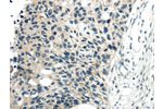 The image on the left is immunohistochemistry of paraffin-embedded Human esophagus cancer tissue using CSB-PA066718(CYP19A1 Antibody) at dilution 1/30, on the right is treated with synthetic peptide. (Original magnification: 