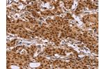 The image on the left is immunohistochemistry of paraffin-embedded Human gastic cancer tissue using CSB-PA066793(CTNNBL1 Antibody) at dilution 1/50, on the right is treated with fusion protein. (Original magnification: 