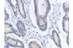 The image on the left is immunohistochemistry of paraffin-embedded Human colon cancer tissue using CSB-PA067150(ACTR3B Antibody) at dilution 1/15, on the right is treated with fusion protein. (Original magnification: 