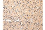 The image on the left is immunohistochemistry of paraffin-embedded Human liver cancer tissue using CSB-PA068096(COL8A2 Antibody) at dilution 1/20, on the right is treated with synthetic peptide. (Original magnification: 