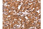 The image on the left is immunohistochemistry of paraffin-embedded Human thyroid cancer tissue using CSB-PA068193(ARL4A Antibody) at dilution 1/60, on the right is treated with fusion protein. (Original magnification: 