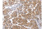 The image on the left is immunohistochemistry of paraffin-embedded Human breast cancer tissue using CSB-PA068230(CLDN3 Antibody) at dilution 1/25, on the right is treated with synthetic peptide. (Original magnification: 