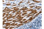 The image on the left is immunohistochemistry of paraffin-embedded Human liver cancer tissue using CSB-PA068462(AIFM1 Antibody) at dilution 1/30, on the right is treated with fusion protein. (Original magnification: 