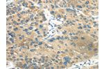 The image on the left is immunohistochemistry of paraffin-embedded Human liver cancer tissue using CSB-PA068483(CD70  Antibody) at dilution 1/40, on the right is treated with synthetic peptide. (Original magnification: 