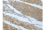 The image on the left is immunohistochemistry of paraffin-embedded Human liver cancer tissue using CSB-PA068489(AMPH Antibody) at dilution 1/25, on the right is treated with fusion protein. (Original magnification: 