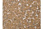 The image on the left is immunohistochemistry of paraffin-embedded Human thyroid cancer tissue using CSB-PA068521(AHSG Antibody) at dilution 1/60, on the right is treated with fusion protein. (Original magnification: 
