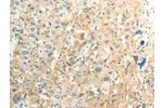 The image on the left is immunohistochemistry of paraffin-embedded Human esophagus cancer tissue using CSB-PA068600(FAT3 Antibody) at dilution 1/30, on the right is treated with synthetic peptide. (Original magnification: 