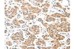 The image on the left is immunohistochemistry of paraffin-embedded Human breast cancer tissue using CSB-PA069429(ADCK1 Antibody) at dilution 1/40, on the right is treated with fusion protein. (Original magnification: 