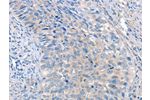 The image on the left is immunohistochemistry of paraffin-embedded Human cervical cancer tissue using CSB-PA069457(ADAM10 Antibody) at dilution 1/35, on the right is treated with fusion protein. (Original magnification: 