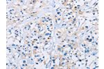 The image on the left is immunohistochemistry of paraffin-embedded Human thyroid cancer tissue using CSB-PA070366(CD33 Antibody) at dilution 1/30, on the right is treated with fusion protein. (Original magnification: 