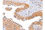 The image on the left is immunohistochemistry of paraffin-embedded Human cervical cancer tissue using CSB-PA070672(AP1B1 Antibody) at dilution 1/70, on the right is treated with synthetic peptide. (Original magnification: 