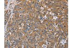 The image on the left is immunohistochemistry of paraffin-embedded Human esophagus cancer tissue using CSB-PA070925(ACTN4 Antibody) at dilution 1/60, on the right is treated with fusion protein. (Original magnification: 