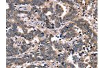 The image on the left is immunohistochemistry of paraffin-embedded Human liver cancer tissue using CSB-PA070949(FGFR1OP2 Antibody) at dilution 1/40, on the right is treated with fusion protein. (Original magnification: 