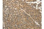 The image on the left is immunohistochemistry of paraffin-embedded Human liver cancer tissue using CSB-PA071225(EIF2AK3 Antibody) at dilution 1/30, on the right is treated with fusion protein. (Original magnification: 