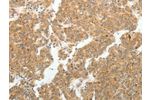 The image on the left is immunohistochemistry of paraffin-embedded Human liver cancer tissue using CSB-PA071725(GEMIN2 Antibody) at dilution 1/40, on the right is treated with synthetic peptide. (Original magnification: 