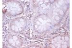 Immunohistochemistry of paraffin-embeded human colorectal carcinoma using CSB-PA07174A0Rb at dilution of 1:100