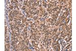 The image on the left is immunohistochemistry of paraffin-embedded Human gastic cancer tissue using CSB-PA072040(GCSAM Antibody) at dilution 1/40, on the right is treated with synthetic peptide. (Original magnification: 