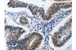 The image on the left is immunohistochemistry of paraffin-embedded Human colon cancer tissue using CSB-PA072508(BPIFB1 Antibody) at dilution 1/40, on the right is treated with synthetic peptide. (Original magnification: 