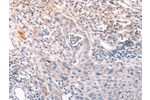 The image on the left is immunohistochemistry of paraffin-embedded Human cervical cancer tissue using CSB-PA072731(A4GNT Antibody) at dilution 1/30, on the right is treated with fusion protein. (Original magnification: 