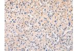 The image on the left is immunohistochemistry of paraffin-embedded Human liver cancer tissue using CSB-PA072803(APLN Antibody) at dilution 1/20, on the right is treated with synthetic peptide. (Original magnification: 