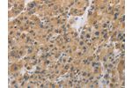 The image on the left is immunohistochemistry of paraffin-embedded Human liver cancer tissue using CSB-PA072935(CYFIP2 Antibody) at dilution 1/25, on the right is treated with fusion protein. (Original magnification: 