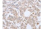 The image on the left is immunohistochemistry of paraffin-embedded Human breast cancer tissue using CSB-PA072974(ABHD5 Antibody) at dilution 1/10, on the right is treated with fusion protein. (Original magnification: 