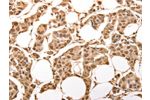 The image on the left is immunohistochemistry of paraffin-embedded Human breast cancer tissue using CSB-PA073168(ACO2 Antibody) at dilution 1/30, on the right is treated with synthetic peptide. (Original magnification: 