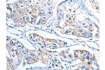The image on the left is immunohistochemistry of paraffin-embedded Human breast cancer tissue using CSB-PA073477(ADSL Antibody) at dilution 1/20, on the right is treated with fusion protein. (Original magnification: 