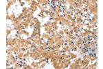 The image on the left is immunohistochemistry of paraffin-embedded Human thyroid cancer tissue using CSB-PA073505(CDR2 Antibody) at dilution 1/60, on the right is treated with fusion protein. (Original magnification: 