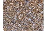 The image on the left is immunohistochemistry of paraffin-embedded Human thyroid cancer tissue using CSB-PA073623(GALK1 Antibody) at dilution 1/40, on the right is treated with fusion protein. (Original magnification: 