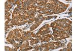 The image on the left is immunohistochemistry of paraffin-embedded Human breast cancer tissue using CSB-PA073786(DLL4 Antibody) at dilution 1/40, on the right is treated with fusion protein. (Original magnification: 