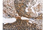 The image on the left is immunohistochemistry of paraffin-embedded Human esophagus cancer tissue using CSB-PA073827(CNGA1 Antibody) at dilution 1/40, on the right is treated with synthetic peptide. (Original magnification: 