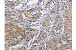 The image on the left is immunohistochemistry of paraffin-embedded Human lung cancer tissue using CSB-PA074141(AGBL5 Antibody) at dilution 1/30, on the right is treated with fusion protein. (Original magnification: 