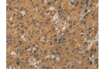 The image on the left is immunohistochemistry of paraffin-embedded Human liver cancer tissue using CSB-PA074176(CYP17A1 Antibody) at dilution 1/20, on the right is treated with fusion protein. (Original magnification: 