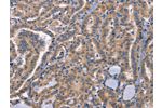 The image on the left is immunohistochemistry of paraffin-embedded Human thyroid cancer tissue using CSB-PA074453(CD48 Antibody) at dilution 1/50, on the right is treated with synthetic peptide. (Original magnification: 